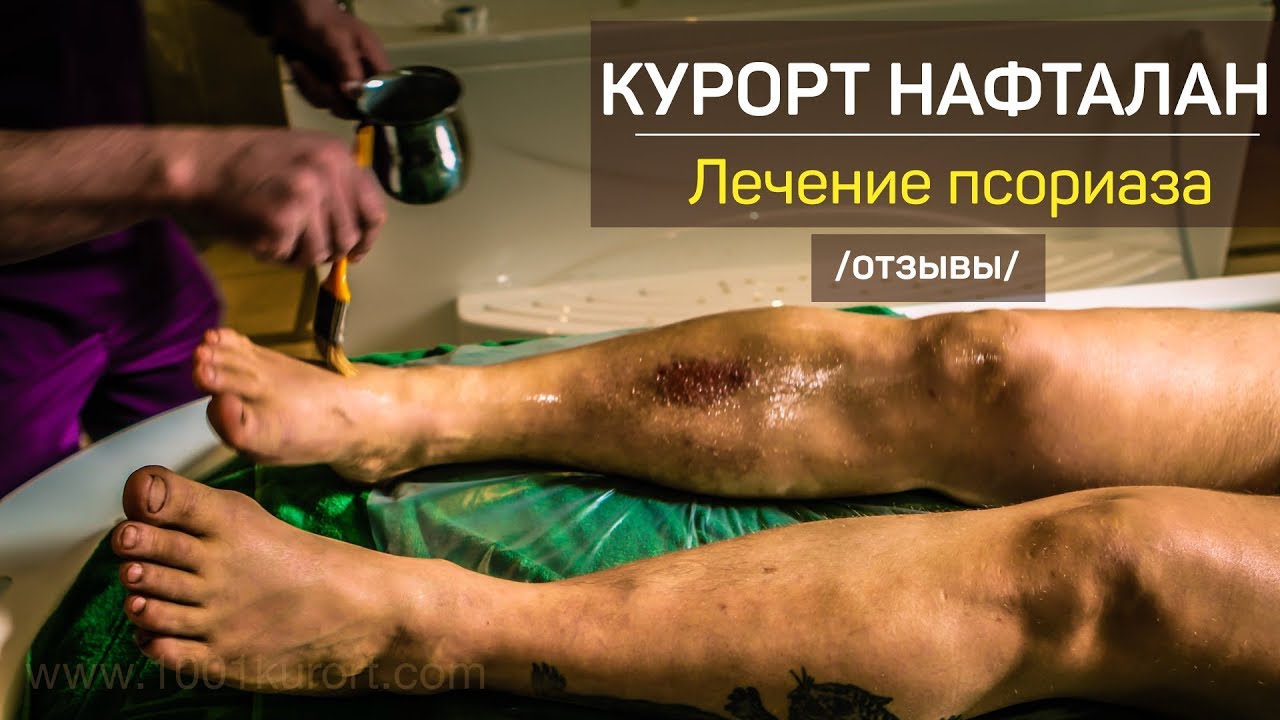Заболевание - псориаз виды и методы лечения в Анапе