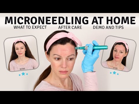 Microneedling at Home with Dr. Pen | Entire Process | 10 Days of Updates | What to Expect (2021)