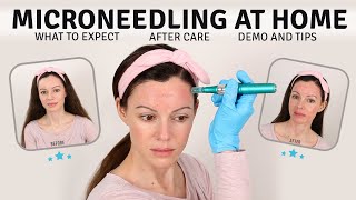 Microneedling at Home | My Most Comprehensive Video On the Process | 10 Days of Updates