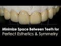 How to Minimize Space Between Teeth to Maximize Esthetics &amp; Symmetry