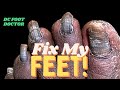 Fix My Feet: Trimming Fungal Toenails For A Cancer Patient