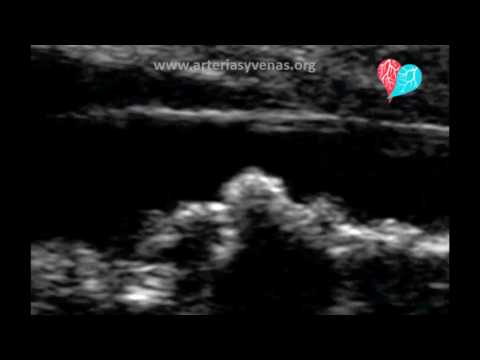 Video: Tromboembolia E Aortës