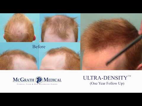Best Hair Transplant Auckland Call Dhi Nz On 09 887 4474