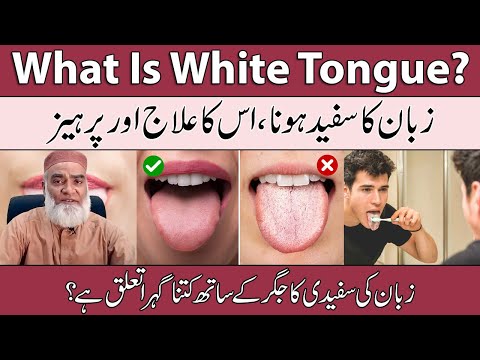 سفید زبان کیا ہے؟ | سفید زبان کا علاج | ثوبان کا محفوظ ہونا اردو | الرزاقی کی صحت بحال