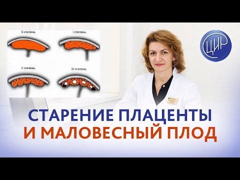 Старение плаценты, маловесный