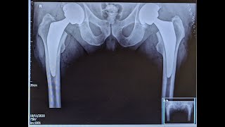 Double Hip Replacement vlog