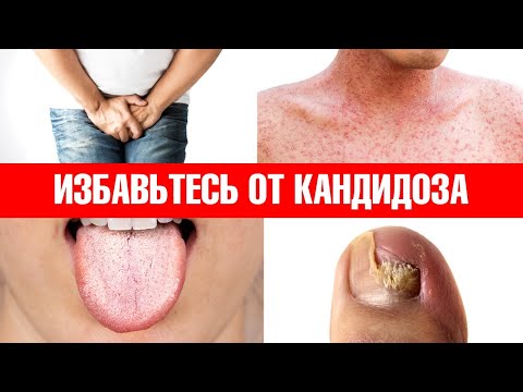 Video: Candida albicans-a qarşı allergiyanız ola bilərmi?