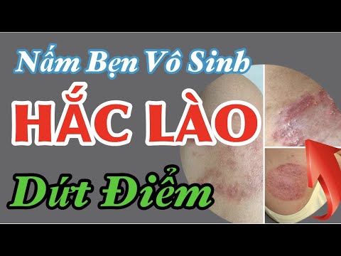 Cái Bẹn Là Gì - Khắc Tinh Của Bệnh Hắc Lào ( Lác), Nấm Bẹn - Dứt điểm KHÔNG Tái Phát