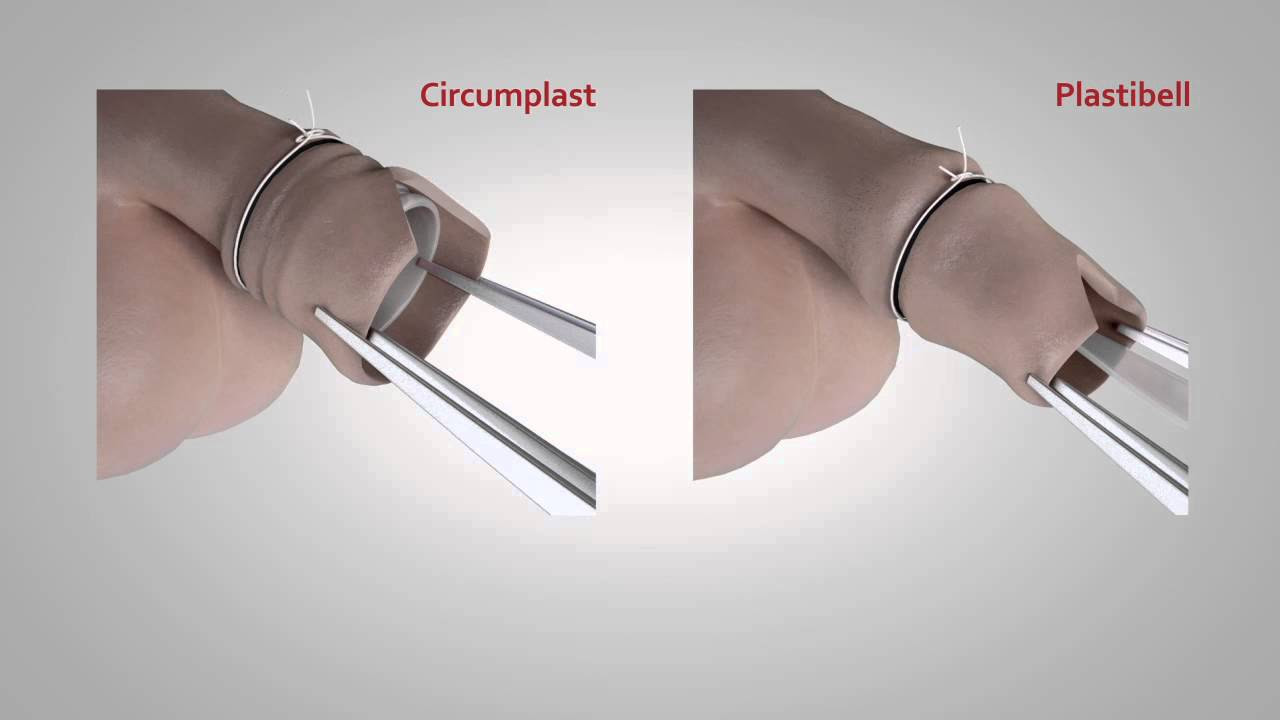China Adult Circumcision Device, Shang Ring, Shang Ring Circumcision Kit  Suppliers, Manufacturers, Factory - SHANGRING