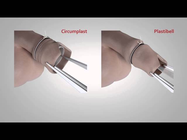 ShangRing Circumcision Device Could Boost HIV Prevention Efforts | Newsroom  | Weill Cornell Medicine