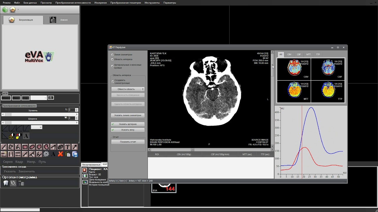 MultiVox - обработка КТ Перфузии