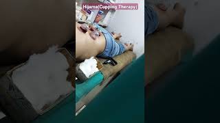 Hijama(Cupping Therapy)shorts  cupping hijama new trending trendingshorts