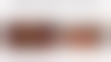 Hybrid Operation of Complex, Bilateral and MultiLevel Atherosclerosis Preserving Deep Femoral Artery