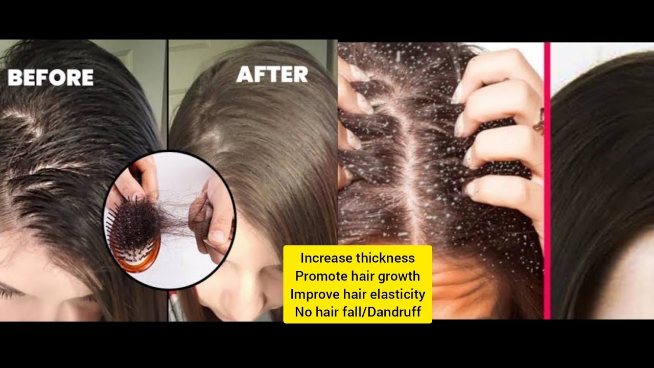 Hair treatment at home /Hairgrowth/Dandruff treatment/Thick hair/Home