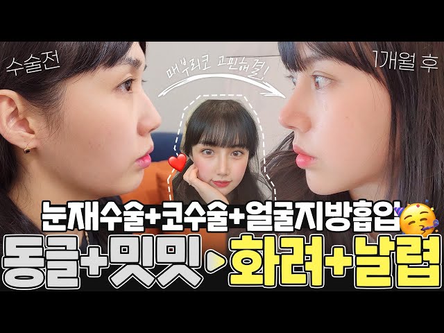 과하지 않은 성형이이란 이런 것?      #메부리코 #눈재수술 #얼굴지방흡입