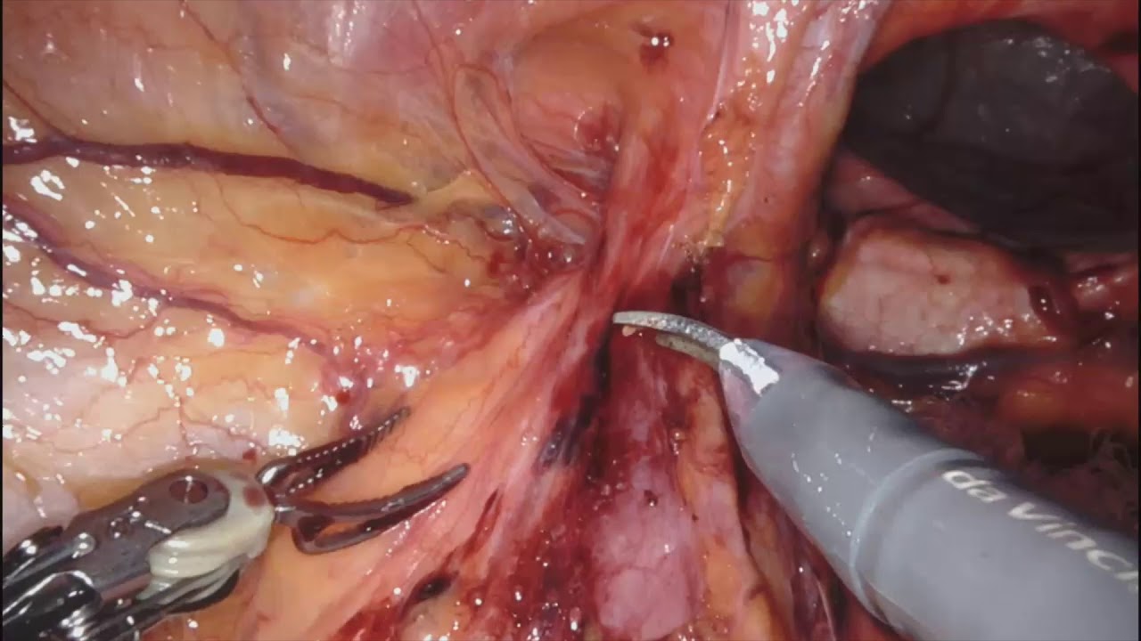 video phone beyonce mp3 Robotic Bilateral Inguinal Hernia Repair