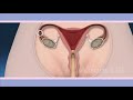 Let us see how a child is formed in sex. What happens inside the vagina after the penis is inserted?