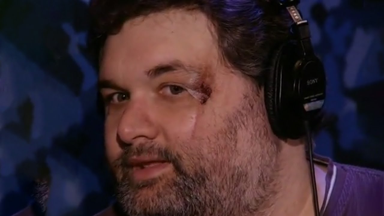 Artie's eye injury
