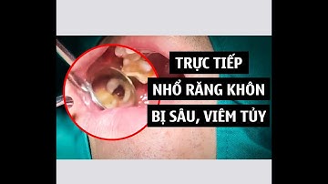 Trực tiếp nhổ răng khôn bị sâu vào tủy gây đau nhức