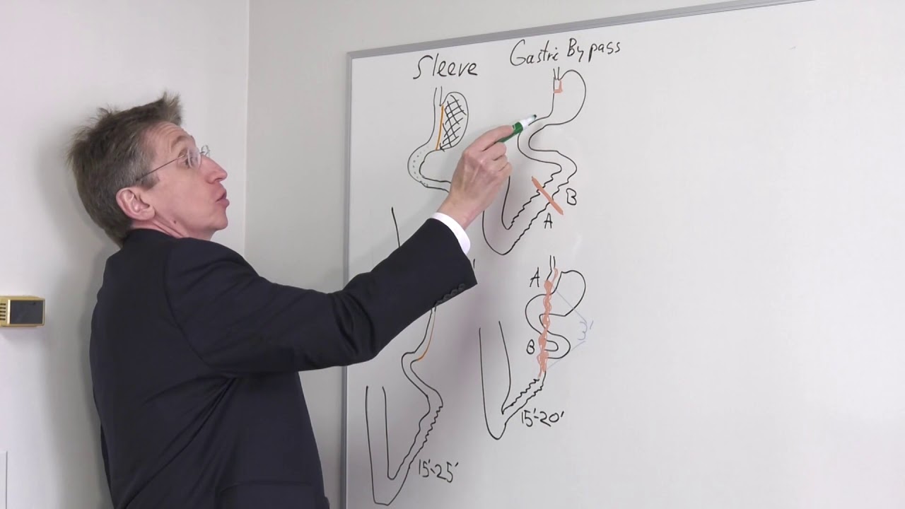 Part 0 Weight Loss Surgeries Explained YouTube