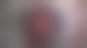 5 0 Prolene Lasso Fixation of Dislocated IOL Capsule Complex