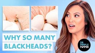 BLACKHEADS AFTER BLACKHEADS They Just Keep Getting Better