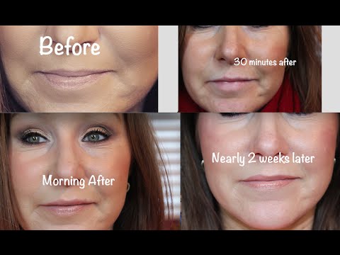 Lip Filler Experience Before & After - YouTube