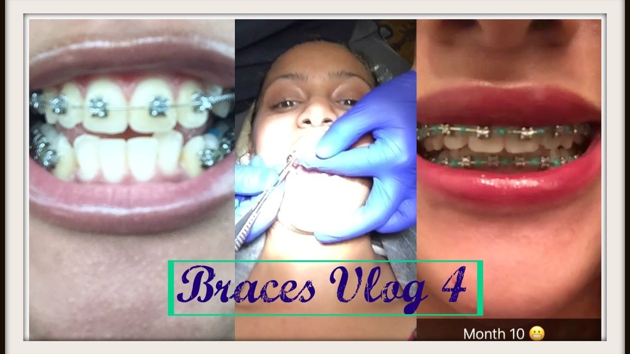 BRACES VLOG 4 Months 4 10 Ortho visit Rubberbands 