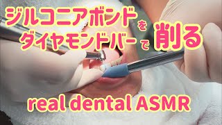 Real Dental ASMR ジルコニアボンドをダイヤモンドバーで削る