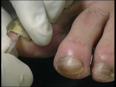 JoF | Free Full-Text | Post-Traumatic Single-Digit Onychomycosis