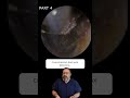 CHALLENGING EAR WAX REMOVAL