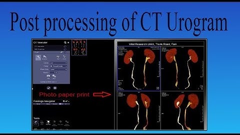 Post processing of  ct urogram
