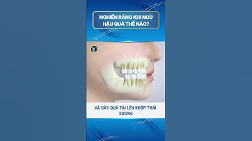 Hậu quả của việc nghiến răng khi ngủ.  #nhakhoavietanh #kienthuc #nhakhoauytin