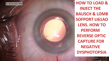 How to Load Bausch & Lomb Sofport LI61AO Lens. Reverse Optic Capture for Negative Dysphotopsia.