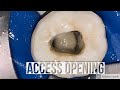 Mandibular Molar Access opening