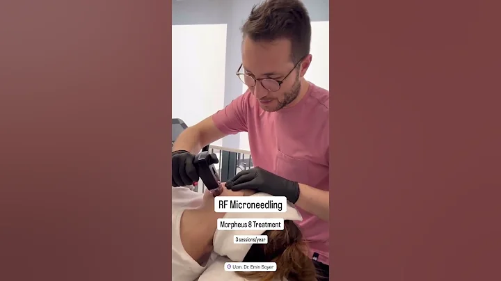 ✨ RF Microneedling with Morpheus 8 | The Secret to Tight & Youthful Skin! | Dr. Emin Soyer