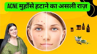 Acne & Pimples Solution ! Complete Skincare Guide 🌿 Best Products + Home Remedies ! Spotless Skin