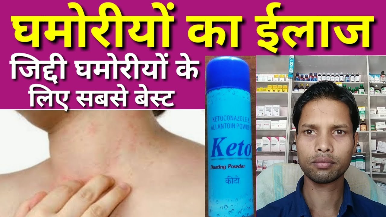 best antifungal shampoo for humans मात्र 2 दिन में घमोरियों का ईलाज II Keto Dusting Powder Uses In Hindi II