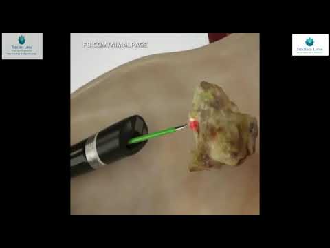 R.I.R.S ADVANCE LASER KIDNEY STONE SURGERY BY DR HARSHAWARDHAN TANWAR (NO CUTS SURGERY)