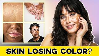 Vitiligo भनेको के हो र किन हुन्छ? | What is Vitiligo & Why it Happens | Dr. Rupak Ghimire