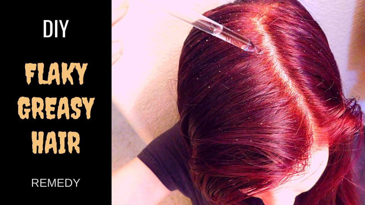 DIY CLARIFYING SHAMPOO // How To Get Rid of Oily Flaky Hair Fast!