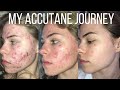 How i cleared my acne  accutane skincare  more