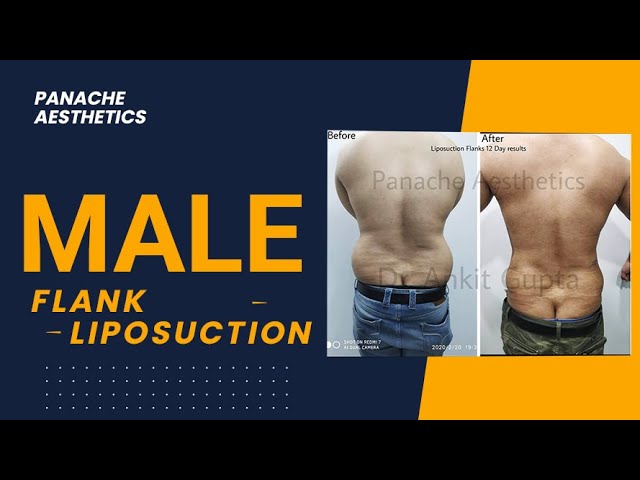 Flanks Liposuction  Before and After Photos - Palm Clinic