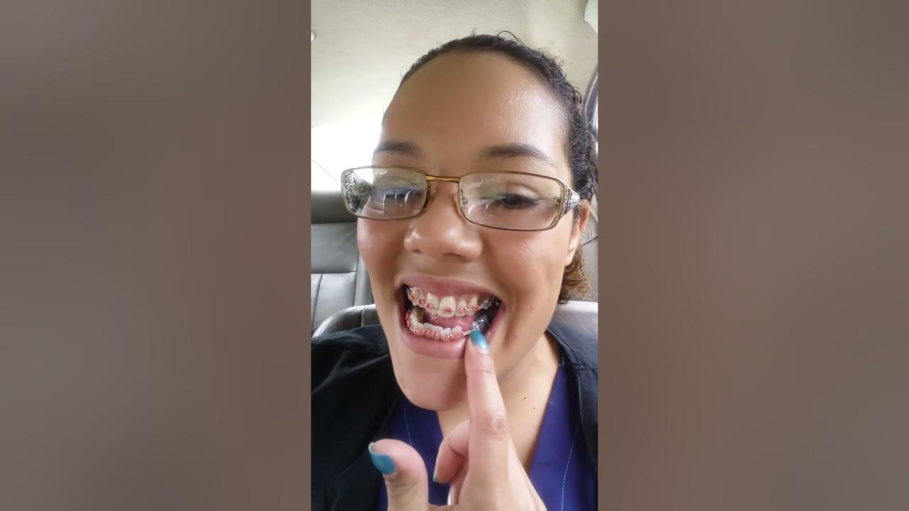 Adult braces \ first time getting them tightened and chains YouTube