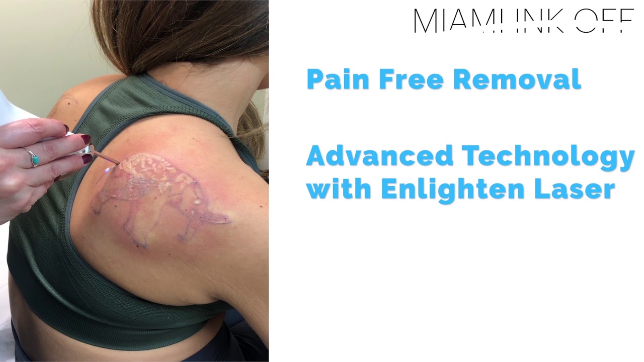 Laser Tattoo Removal Miami  Tattoo Removal Hollywood  Pembroke Pines