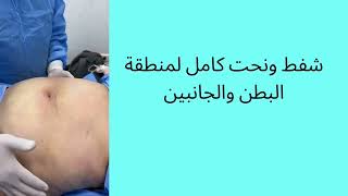 شفط الدهون ونحت كامل لمنطقه البطن والخصر #جراح_تجميل #نحت_الجسم #شفط_الدهون #نحت_البطن