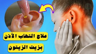 علاج التهاب الأذن الوسطى بزيت الزيتون