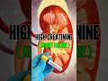 Creatinine levels kaise kam kare? 100% Working Solution #shorts #creatinine