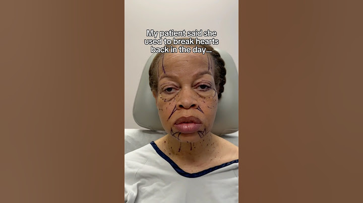 I Took Her Back 20 Years With a Full Face Rejuvenation 🤯