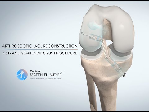 ARTHROSCOPIC ACL RECONSTRUCTION (ST4 PROCEDURE) - DR MATTHIEU MEYER - PARIS, FRANCE